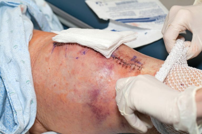 Delayed Pain Relief Seen in Many After Total Knee Arthroplasty