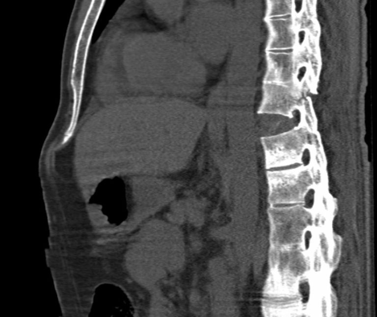 High Prevalence of Undiagnosed Spondyloarthritis in Anterior Uveitis and Chronic Back Pain
